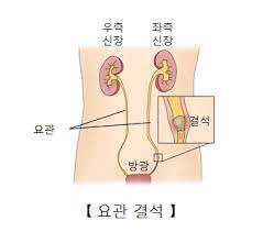 Read more about the article 요로 방광 신장결석 원인 전조증상 통증과 치료비(요관내시경수술)