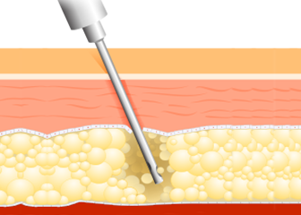 You are currently viewing 내장지방과 무관한 피하지방 제거용 지방흡입술 원리와 유의점