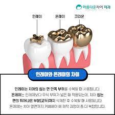 Read more about the article 충치보다 더 아픈 치아염증 급성 치수염과 치아 보철 치료