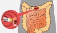 You are currently viewing 대장 내시경에 필요한 대장 용종 크기 AI 인공지능 측정법 세계 최초 개발 특허출원