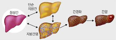 Read more about the article 오래가고 심한 술냄새 원인과 알코올 대사 간건강