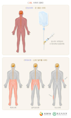 Read more about the article 프로포폴 등 마취 약물의 종류와 전신 마취와 의식 여부