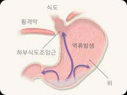 Read more about the article 역류성 식도염 발생시키는 저탄고지 케톤식 다이어트 식단