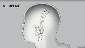 Read more about the article 머스크 뉴럴링크 전자칩 임플란트 뇌 이식 첫 임상 시험 참가자 모집